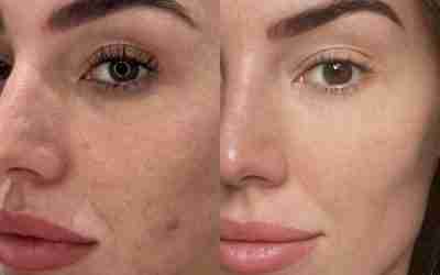 BREAKOUTS AND DULL SKIN