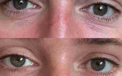 FINE LINES UNDER EYES IMPROVEMENT WITH SKINCARE