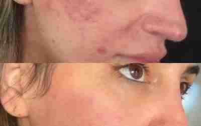 BEFORE AND AFTER BLEMISHES AND REDNESS