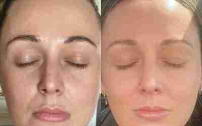 SKIN TEXTURE AND COLOUR IMPROVEMENT